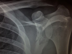 肋骨と肩甲骨陥没骨折の新城幸也、「5月下旬には実戦復帰したい」 画像