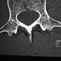 ファビアン・カンチェラーラ（トレックファクトリーレーシング）、脊椎横突起骨折のレントゲン写真