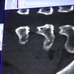 ファビアン・カンチェラーラ（トレックファクトリーレーシング）、脊椎骨横突起骨折のスキャン画像